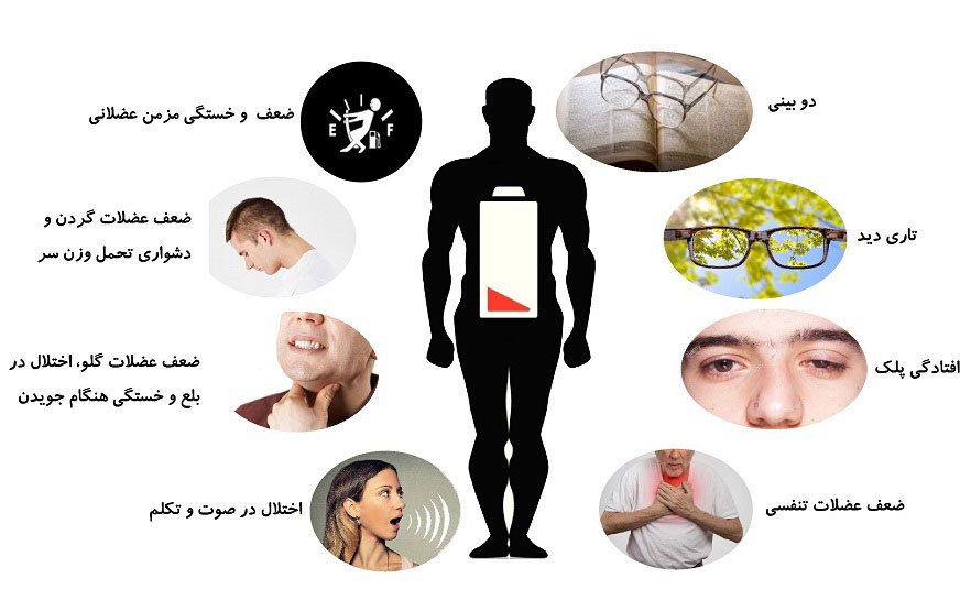 علائم میاستنی گراویس